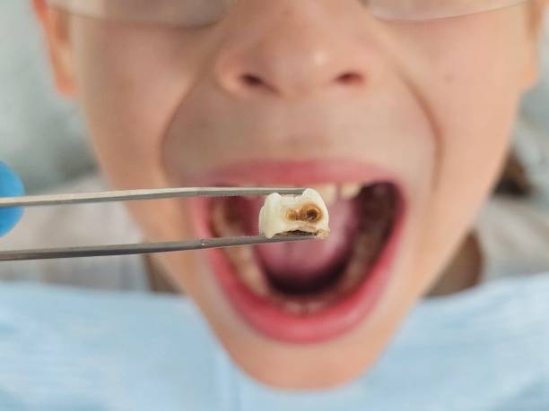 Dentist for Dental Trauma in FL